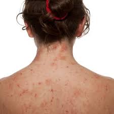 Conheça as suas causas e sintomas, bem como as opções de tratamento disponíveis. Psoriase Brasil Psoriasebr Twitter