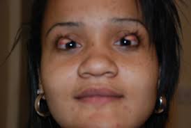 Read more eyelid flip / ky on twitter do you ever just flip you eyelid inside out bbrittyn. Eyelid Flip Steps A Denver Eyelid Surgeon Does To Remove A Stye Or Chalazion The Chronicles Of Trippytrap