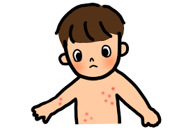 水いぼ 伝染性軟属腫 は自然軽快する可能性はあります では その軟属腫はいつ頃軽快するのでしょうか やや古い報告ですが日本からの報告で 小児217例中205例において 伝染性軟属腫の自然軽快の平 子ども 小児 古い
