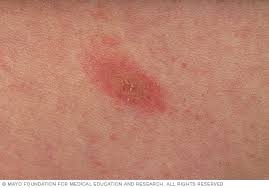 These include diphenhydramine (benadryl, others). Pityriasis Rosea Symptoms And Causes Mayo Clinic