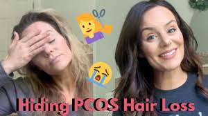 This post falls under one of the symptoms of pcos that many find too embarrassing to talk about. My Emotional And Personal Experience With Advanced Pcos Hair Loss Lauren Stewart Youtube