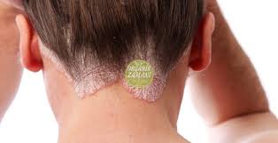 Evde Dogal Egzama Kremi Nasil Yapilir Organik Zamani Eczema Cream Homemade Beauty Homemade Beauty Products