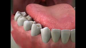 Maybe you would like to learn more about one of these? Dry Socket Alveolar Osteitis Global Indian Nurses Organization