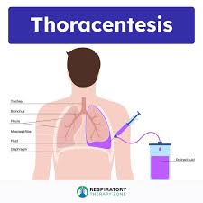 Image result for Thoracentesis