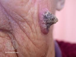 Image result for cornu cutaneum)