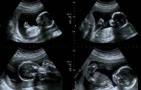 Ultraschall in der Schwangerschaft | Baby gesund? | swissmom