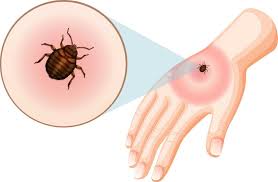 Image result for bedbugs bites