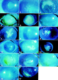 Maybe you would like to learn more about one of these? Detection Of Herpes Simplex Virus Dna In Atypical Epithelial Keratitis Using Polymerase Chain Reaction British Journal Of Ophthalmology