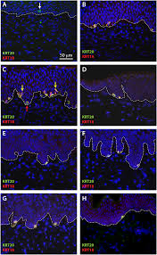 Mcc pathogenesis is associated with either the presence of merkel cell polyomavirus or chronic. Plos One Identification Of Merkel Cells Associated With Neurons In Engineered Skin Substitutes After Grafting To Full Thickness Wounds