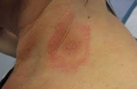 The bite of a hard tick is generally painless, with a feeding process lasting several hours, to days, even weeks. What Do I Do With A Tick Bite Doctors Urgent Care