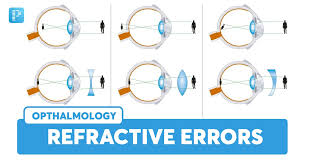 Image result for Refractive Error