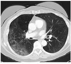 Image result for Incidental Imaging Finding