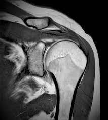 An mri of your shoulder typically takes about 15 to 45 minutes. Shoulder Mri Scan Cost From 225