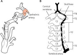 Internal carotid artery dissection (icad) is a clearly identified cause of stroke and accounts for about 20% of strokes in younger patients. Epidemiology Pathophysiology Diagnosis And Management Of Intracranial Artery Dissection The Lancet Neurology
