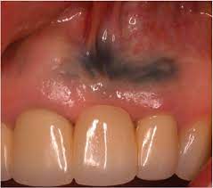 Amalgam tattoo what is an amalgam tattoo? Removal Of An Amalgam Tattoo Using A Subepithelial Connective Tissue Graft And Laser Deepithelialization Semantic Scholar