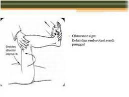 Image result for Obturator Sign