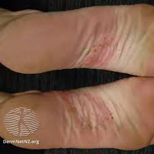 Image result for dyshidrosis