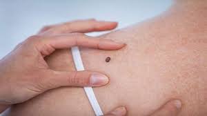 Skin cancers can cause your skin to change color, making it darker, more yellow, or more red. Five Signs The Way You Look Can Mean You Have The Most Serious Skin Cancer