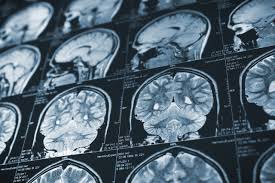 Toxic Encephalopathy? | Masked Canary
