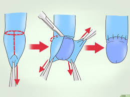 Phimosis information including symptoms, diagnosis, treatment, causes, videos, forums, and local community support. 3 Manieres De Traiter Le Phimosis Grace A Des Etirements Du Prepuce