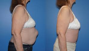 Hernia Repair Abdominal Wall Reconstruction Hernia Repair Abdominal Hernia Abdominal