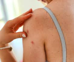 Image result for Eczema nummulare
