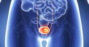 Bladder cancer is any of several types of cancer arising from the tissues of the urinary bladder. The Fascinating Story Behind A New Bladder Cancer Treatment Johnson Johnson