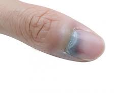 However it might be possible that this is something involving your skin which would need to be assessed by your doctor. Subungual Melanoma Symptoms Risk Factors And Treatment