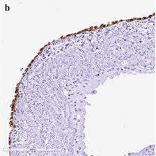 Benign multicystic mesothelioma is a rare benign tumour derived from the. Pdf Benign Multicystic Mesothelioma And Peritoneal Inclusion Cysts Are They The Same Clinical And Histopathological Entities A Systematic Review To Find An Evidence Based Management