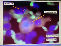 mtap is located adjacent to cdkn2a and is codeleted in 90% of mesothelioma tumors with a cdkn2a homozygous deletion. Tania Labiano On Twitter Great Summary Of New Mesothelial Markers Bap1 Mtap Nuclear Loss W Internal Positive Control In Inflammatory Cells And P16 Loss By Fish Molcytopath20 Thanks Dr Schmitt Cytopath