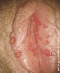Die behandlung einer erstinfektion oder eines rückfalles mit im allgemeinen gilt: Herpes Genitalis