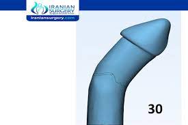 The downward sloping demand curve depends upon this group. 30 Degree Curve Penile Curvature 30 Degrees Iranian Surgery