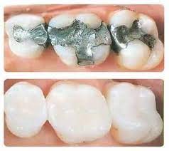 General Concepts Of Health And Toxicity Dr Memoli Berkeley Heights Nj Click To More Details Or Dental Fillings Tooth Colored Fillings Cosmetic Dentistry