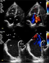 Smaller openings often close normally or would require medical therapy. Recent Review Of Transcatheter Closure Of Atrial Septal Defect Sciencedirect
