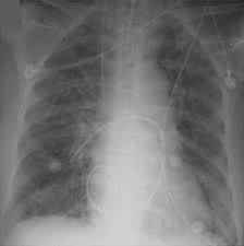 Image result for Hyperviscosity Syndrome