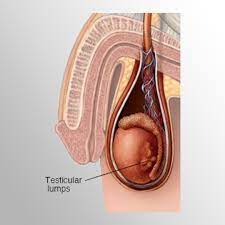 There are 3 stages of testicular cancer: Testicular Cancer Lahari Chanakya