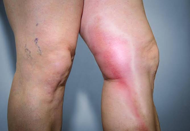 Trombose: o que é, sintomas, causas e dicas para prevenção