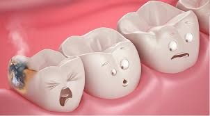 Bacteria are normally present on teeth as plaque. Get Rid Of Cavities With Dental Filling In 2020