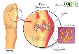 See more of rawatan gout on facebook. 13 Kaedah Merawat Gout Secara Natural Tanpa Ubat Ubatan Kartel Dakwah