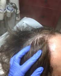 Adim Adim Sac Prp Islemi Prp Platelet Rich Plasma Yani Trombosit Hucrelerinden Zengin Kan Anlamina Gelmektedir P Engagement Rings Engagement Fashion