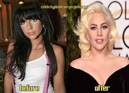 17.09.2021 · after admitting to having numerous plastic surgery procedures including a breast augmentation and lip fillers, courtney stodden, who also got … Lady Gaga Plastic Surgery Experience Celebrity Plastic Surgery Transformation By Anna Maria Medium