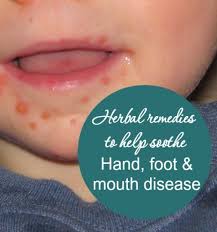 Herbs For Hand Foot And Mouth Disease Hand Foot And Mouth Remedies Herbalism