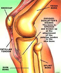 Bodyworks Osgood Schlatter S Disease