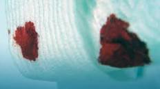 Resultado de imagen para "sangrado rectal"