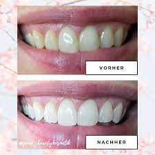 Schöne und gesunde zähne spielen eine wichtige rolle für ihr wohlbefinden, ihre ausstrahlung und ihre lebensqualität. Zahnbleaching Vorher Nachher Zahnbleaching Zahnaufhellung Schone Zahne