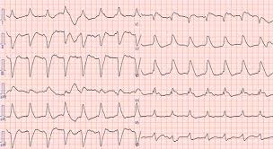 Current trends in diagnosis and treatment. Fulminant Myocarditis Bmj Case Reports