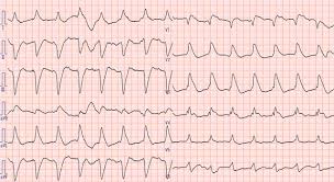 Clinical presentation clinical presentation is variable in severity, ranging from asymptomatic to. Fulminant Myocarditis Bmj Case Reports