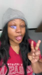 Getting a New Prosthetic Eye After 3 Years