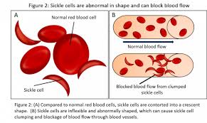 Sickle cell is a recessive genetic blood disorder characterised by red blood cells that assume an. Detecting Hemoglobin Variants During Sickle Cell Disease Research Which Method Is Best Diapharma