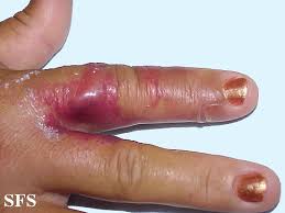 Image result for Erysipeloid